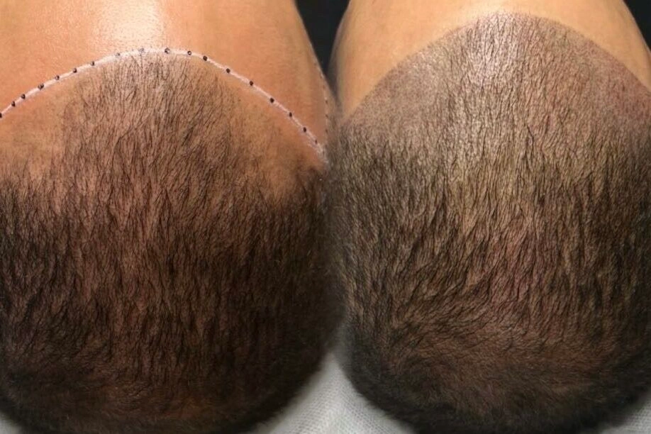 Scalp Micropigmentation Guide