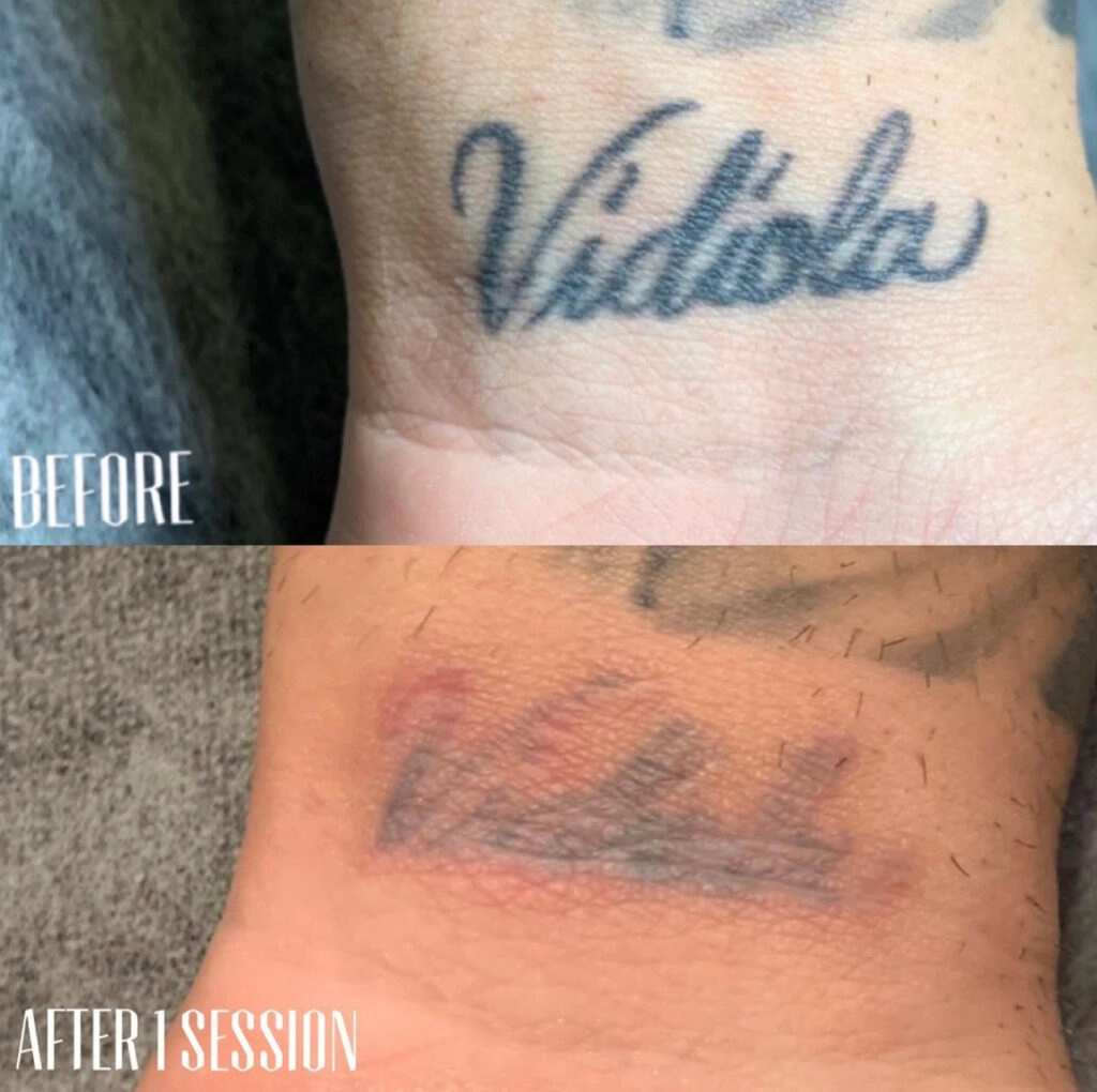 Saline Tattoo Removal